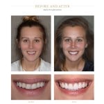 A woman with a more aesthetic smile after dental work