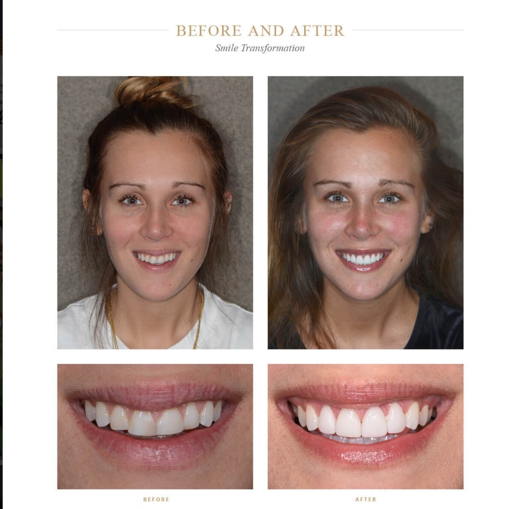A woman with a more aesthetic smile after dental work