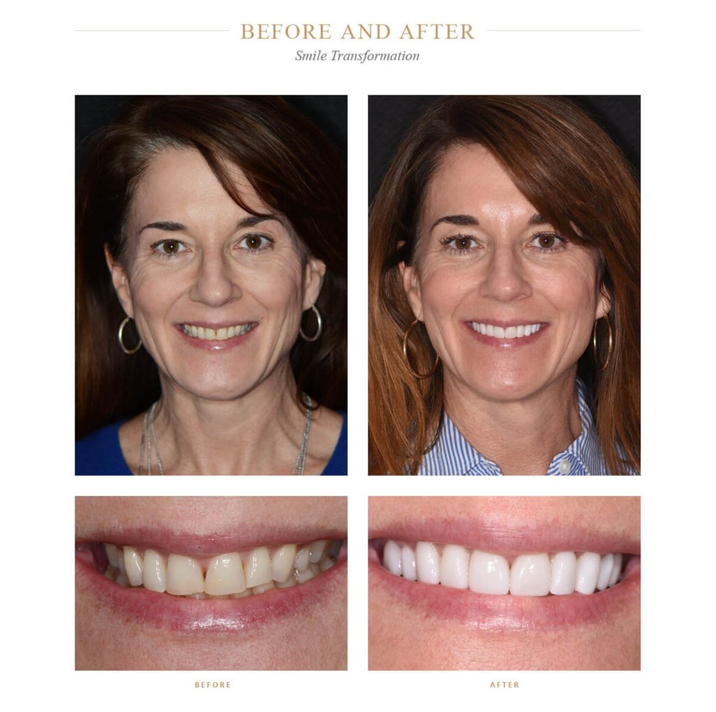 Dull, crooked teeth compared to bright, straight teeth after smile transformation