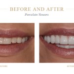 Crooked teeth before and even teeth after porcelain veneers