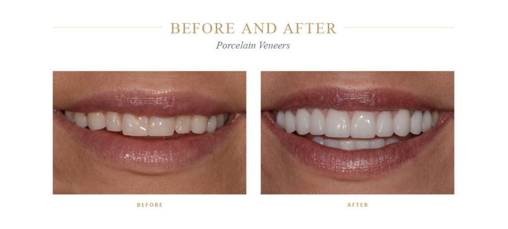 Crooked teeth before and even teeth after porcelain veneers