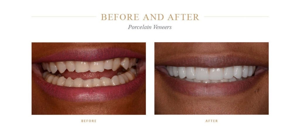 Chipped, dull teeth before and bright, even teeth after porcelain veneers