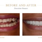 Chipped, dull teeth before and bright, even teeth after porcelain veneers