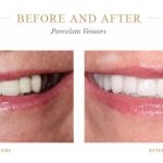 Discolored teeth before and bright, white teeth after porcelain veneers