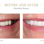 Discolored teeth before and bright, white teeth after porcelain veneers