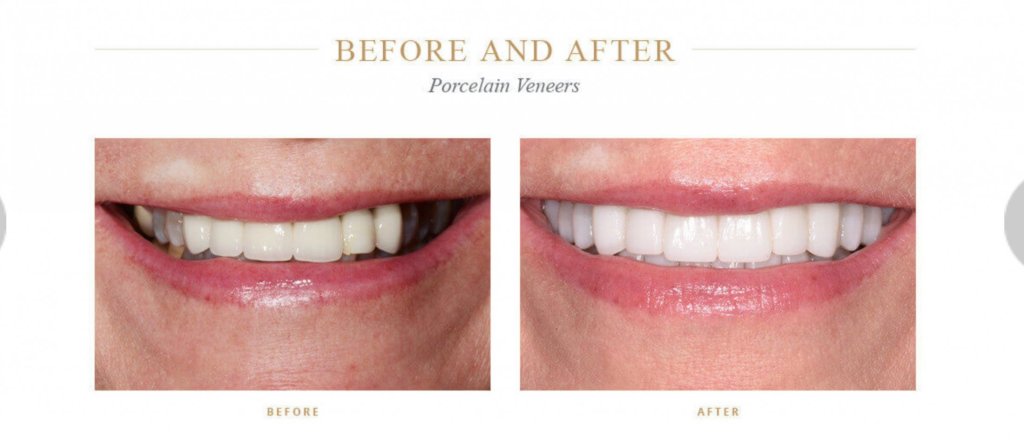 Discolored teeth before and bright, white teeth after porcelain veneers
