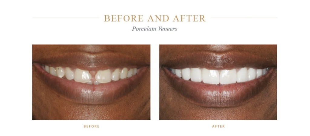 Uneven, dull teeth before and bright beautiful teeth after porcelain veneers