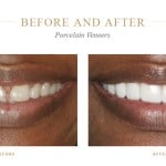 Uneven, dull teeth before and bright beautiful teeth after porcelain veneers