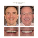 A man with brighter teeth after a smile transformation