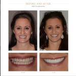 Comparison of a woman's smile before and after dental work