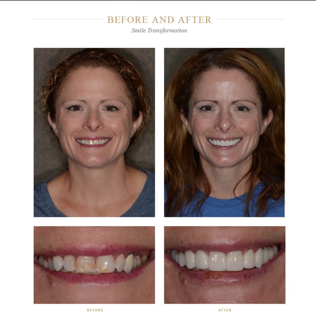 A woman before and after a smile transformation
